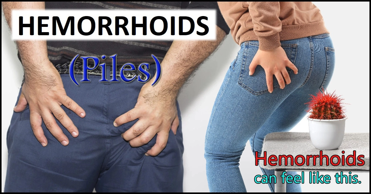 Hemorrhoids