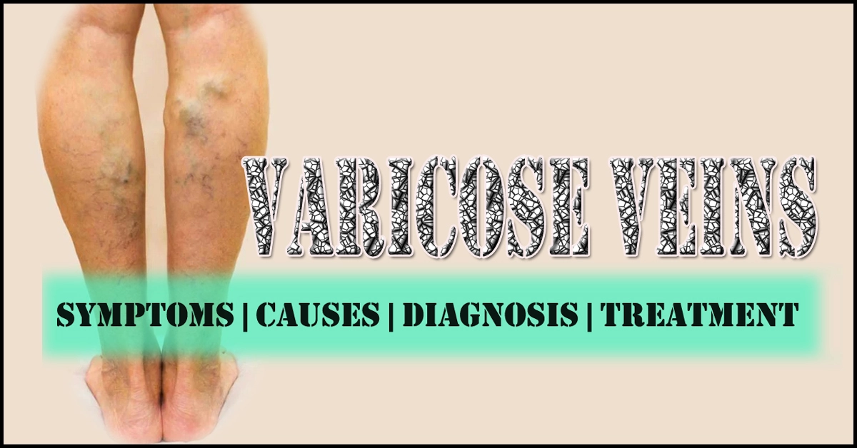 Varicose veins: Causes, Diagnosis & Treatment