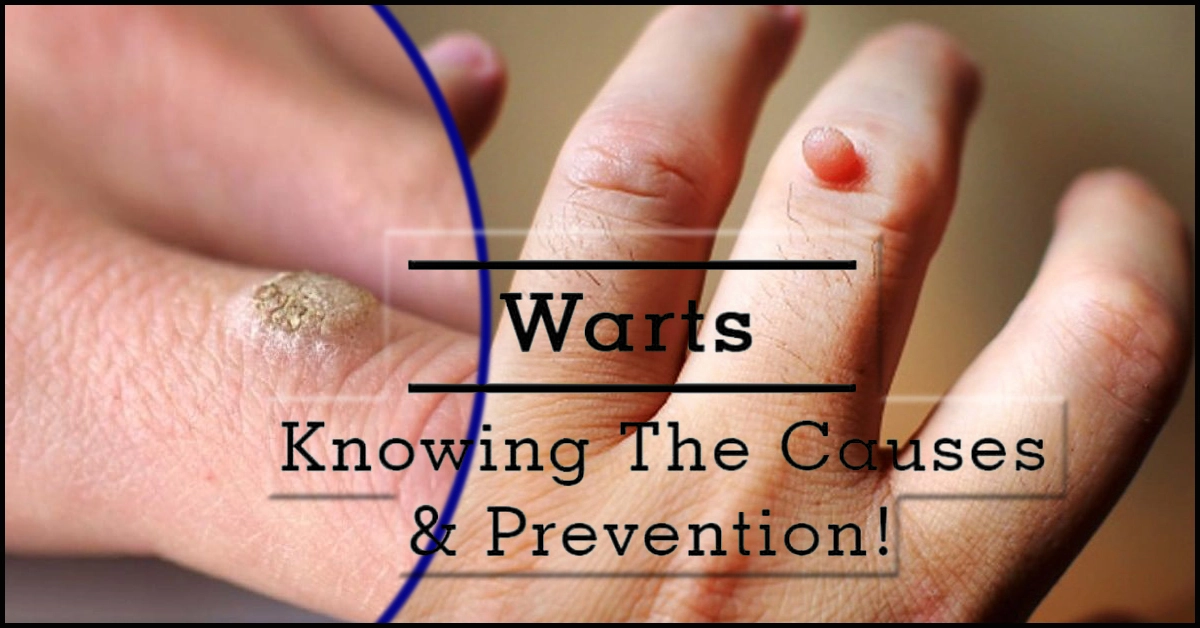 A Wart : Causes, Symptoms & Treatment Options